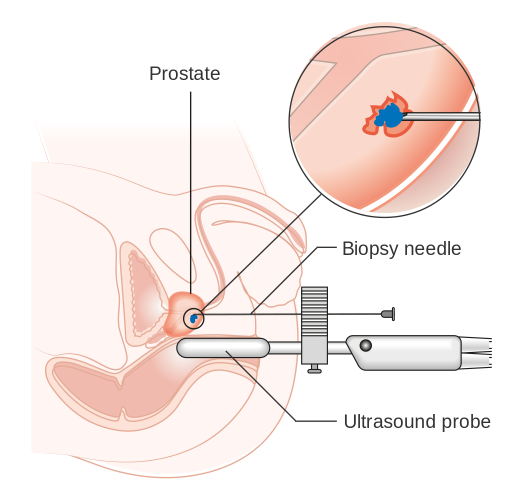 prostate_biopsy
