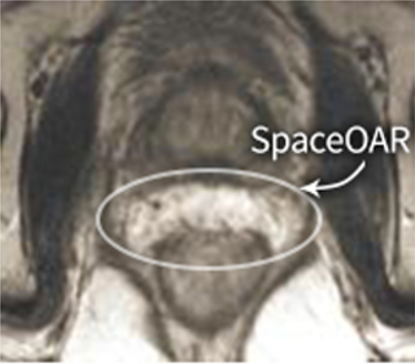 spaceoar_MRI_post
